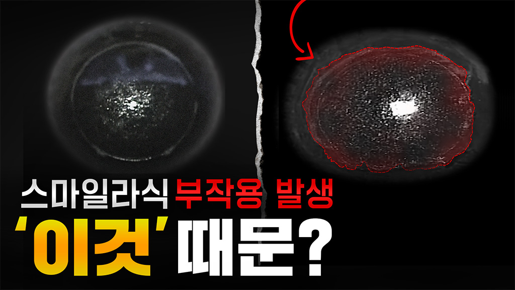 스마일라식 받은 의사가 말하는 부작용 발생 이유