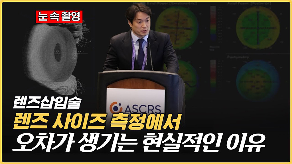 렌즈 사이즈 측정을 잘못하면 벌어지는 일